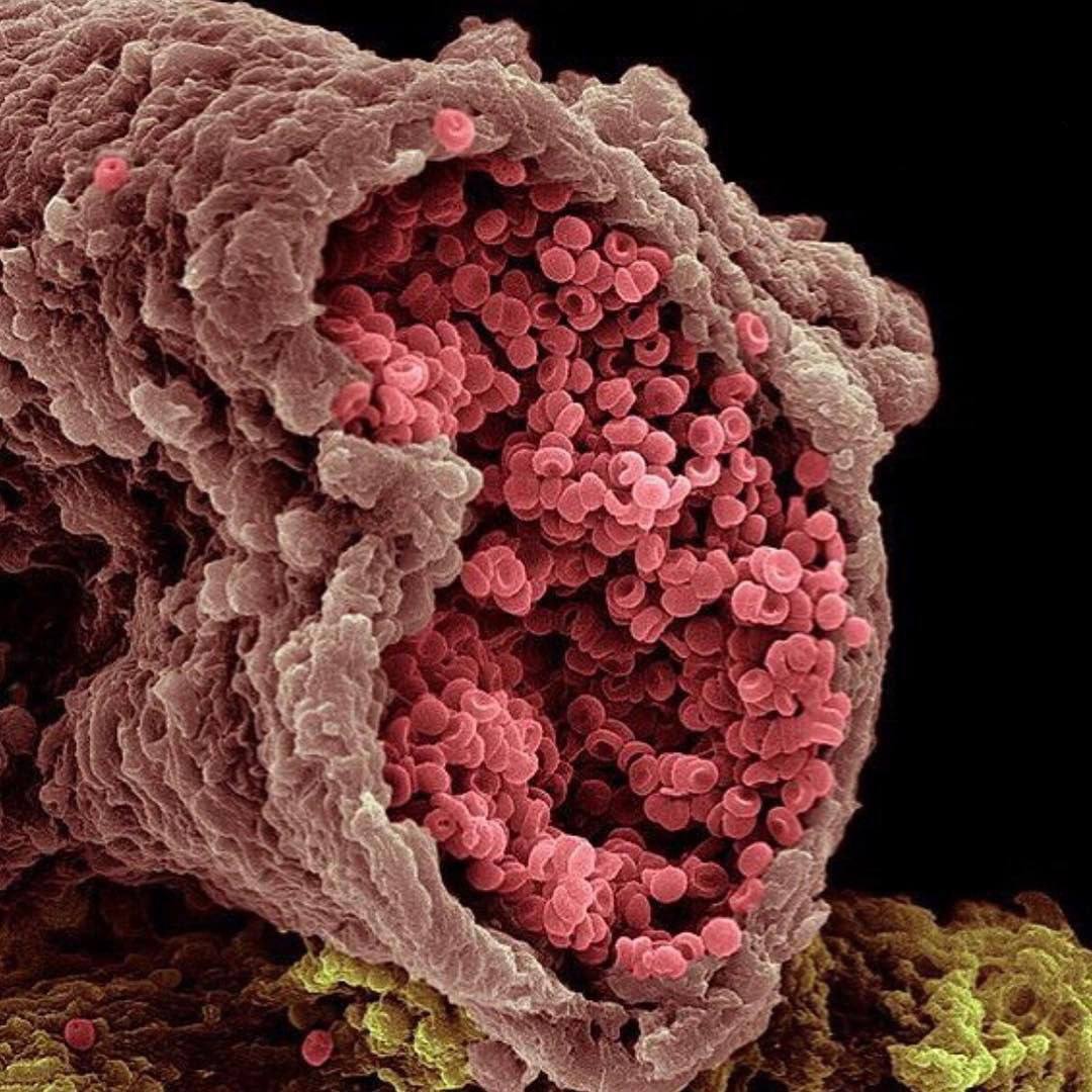 Злокачественный материал. Эритроцит электронный микроскоп. Эритроциты микрофотография. Красные кровяные тельца под микроскопом. Клетки крови под микроскопом.